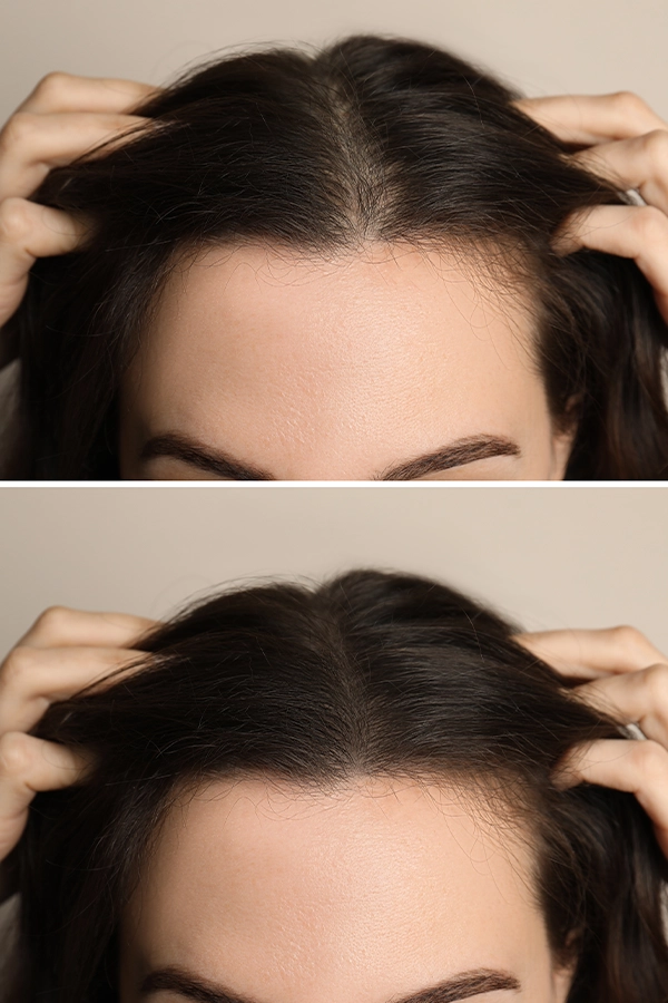 Hair transplant result before after